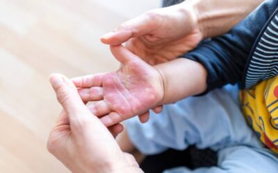 Treating Minor Injuries at Home