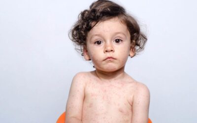 How to recognise and treat mumps, measles, scarlet fever and hand foot and mouth
