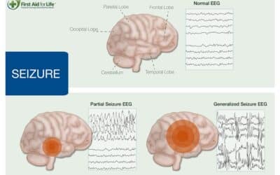 Seizures, Convulsions and Epilepsy – a Complete Guide